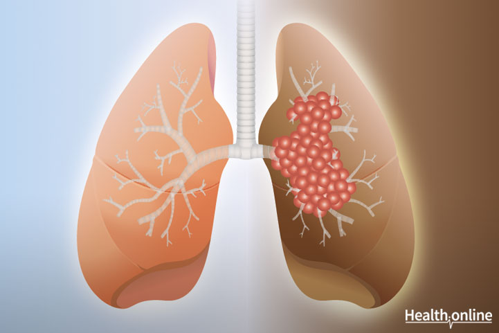 Types of Lung Cancer