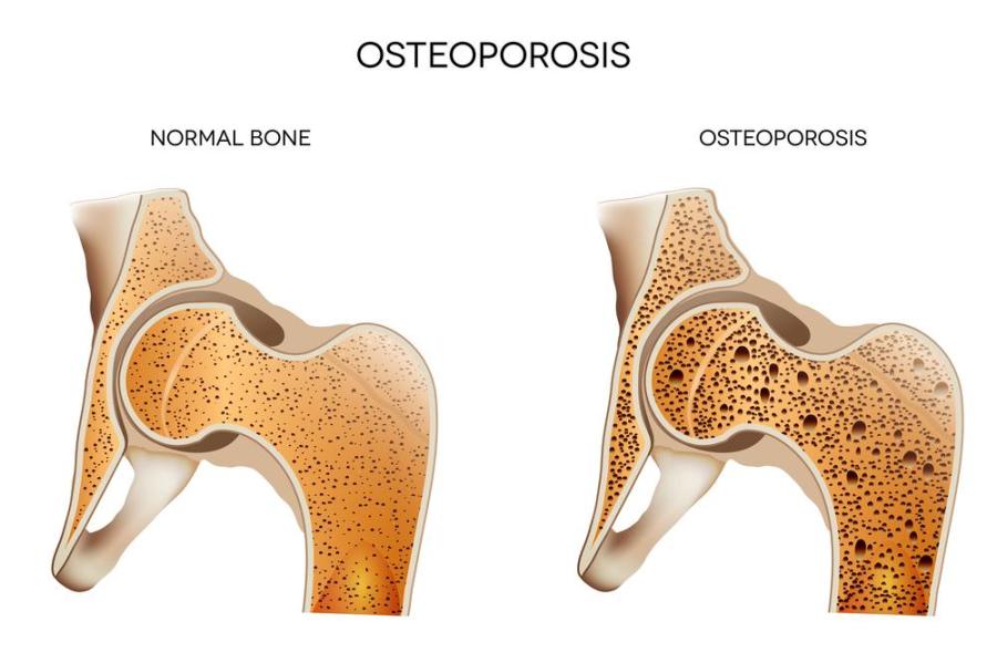 Introduction and Prevalence of Osteoporosis