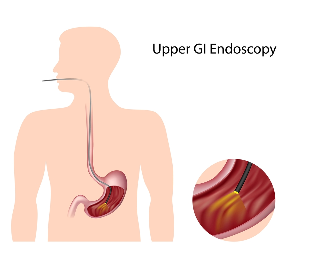 Tests and Diagnosis of GERD