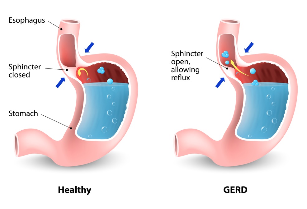 Causes and Complications of GERD