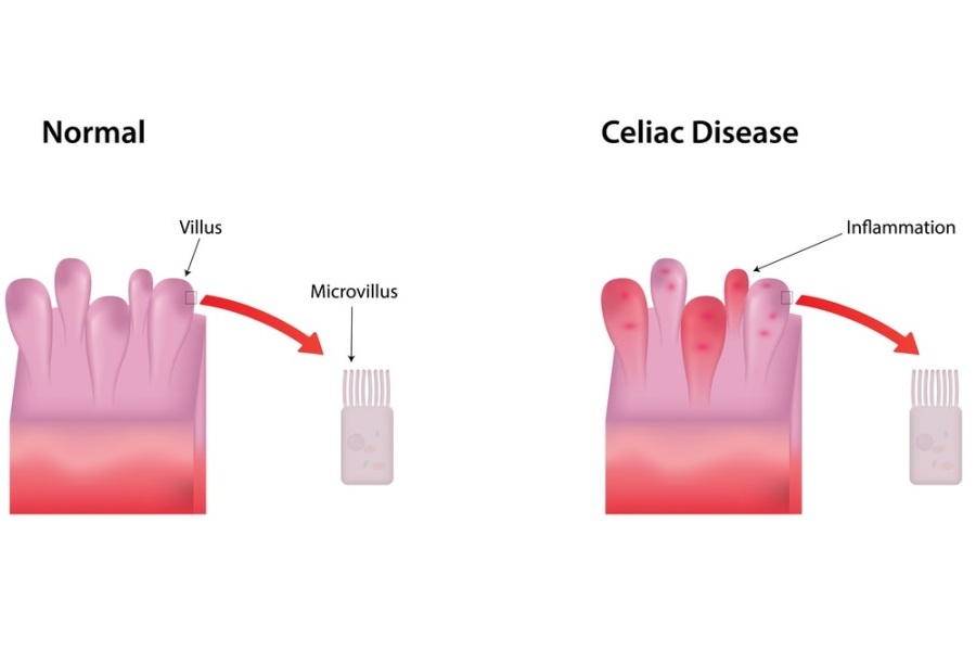 Diagnosis of Celiac Disease