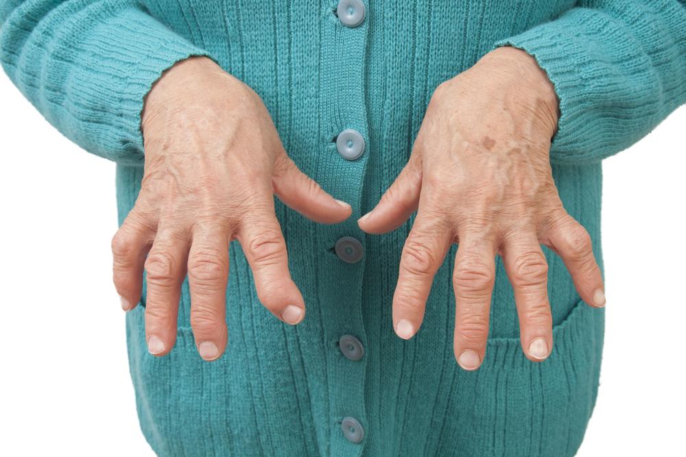 Overview of Rheumatoid Arthritis