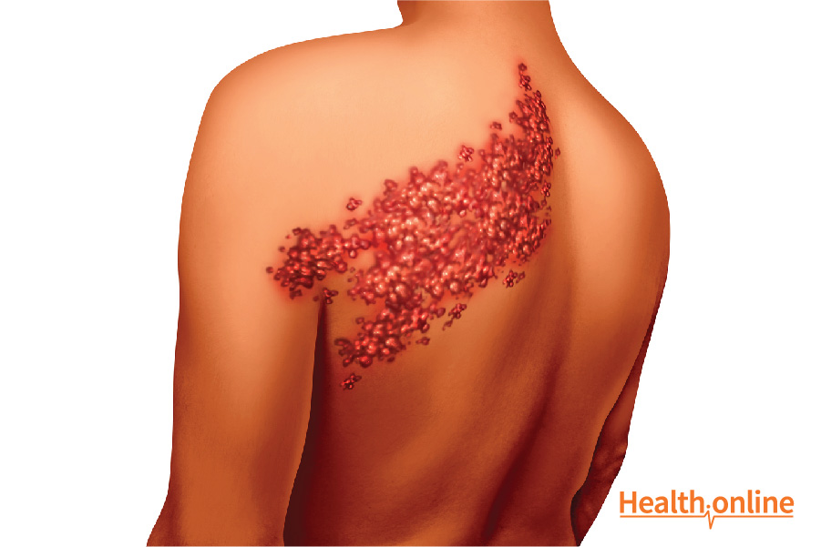 Complications of Shingles