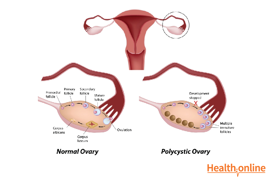 Causes of PCOS