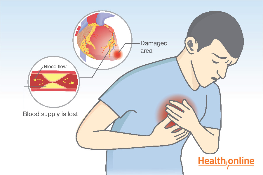 Prevalence and Pathology of Heart Attack