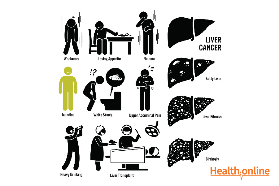 Signs and Symptoms of Liver Cancer