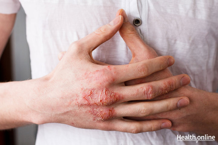 Living and Coping with Psoriasis