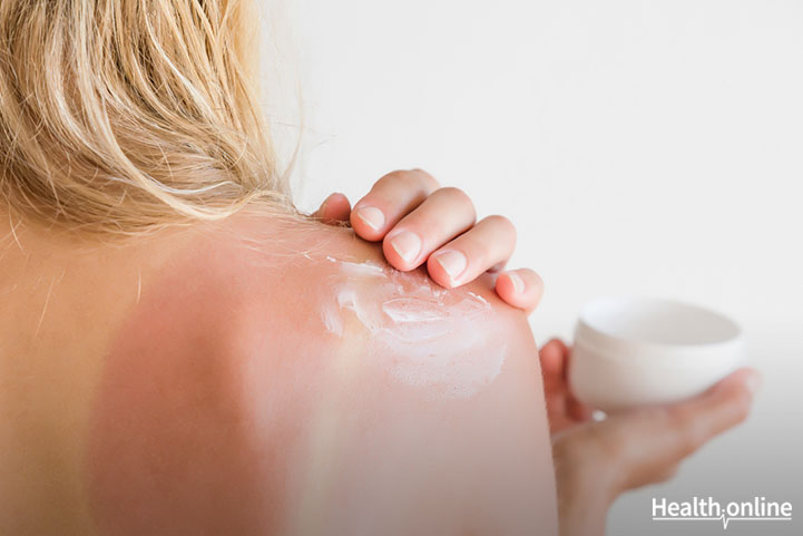 6 Home Remedies for Sunburn