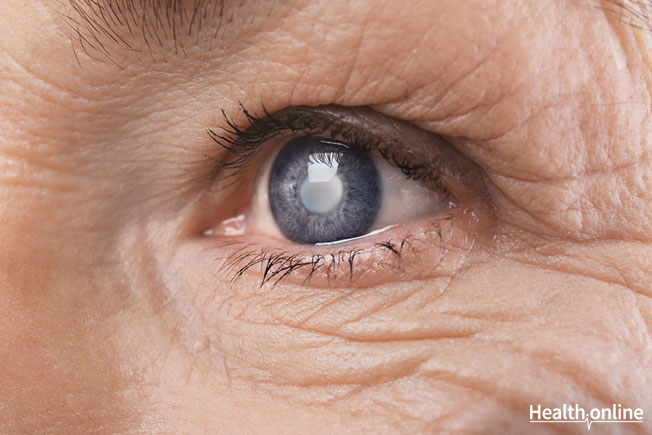 Symptoms and Risk Factors of Cataract