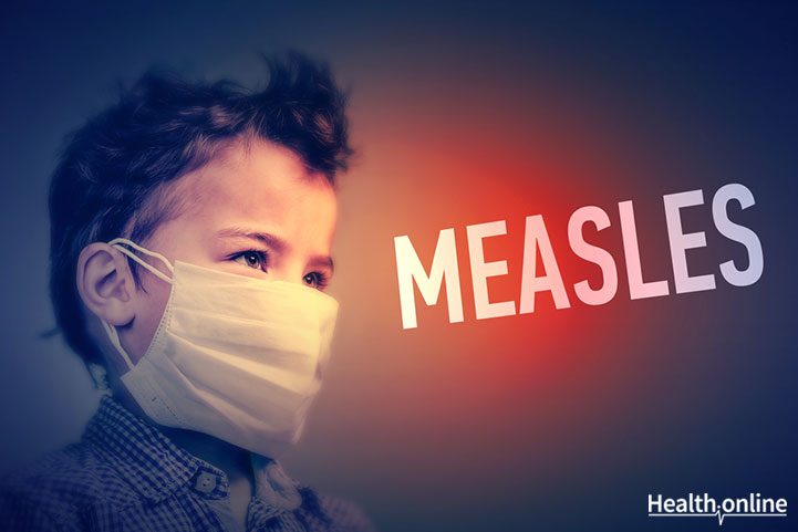 Overview &#038; Causes of Measles