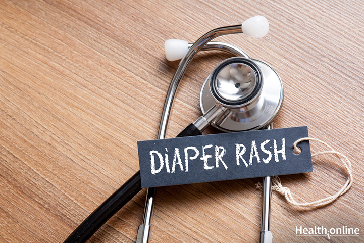 Diaper Rash Remedies to Protect Your Baby&#8217;s Bottom