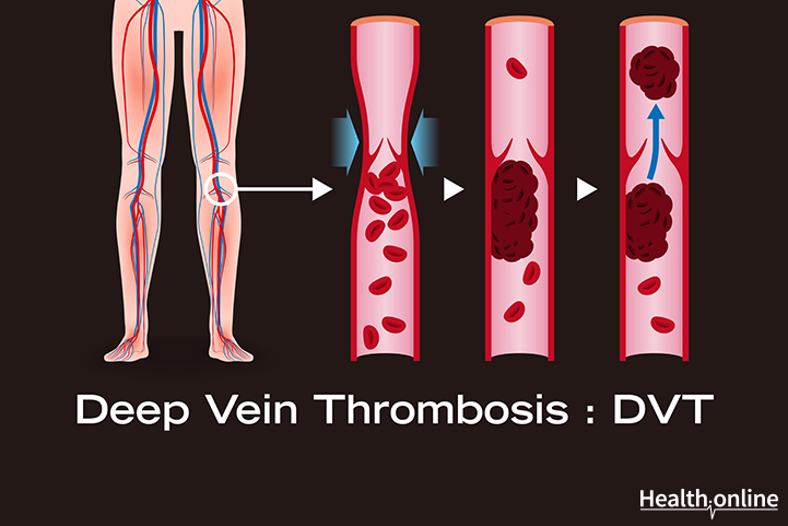 Pathophysiology of DVT