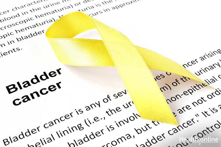 The Common Causes of Bladder Cancer