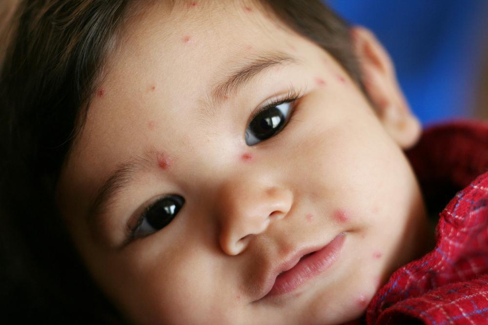 A Brief Introduction to Chickenpox