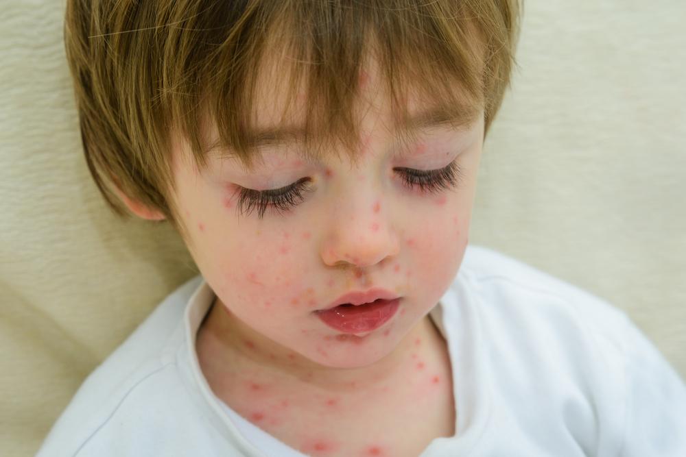 Common symptoms of chickenpox