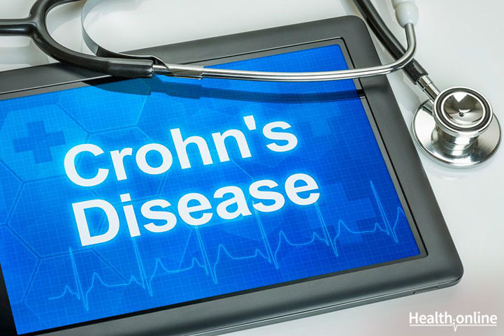 Introduction to Crohn’s Disease
