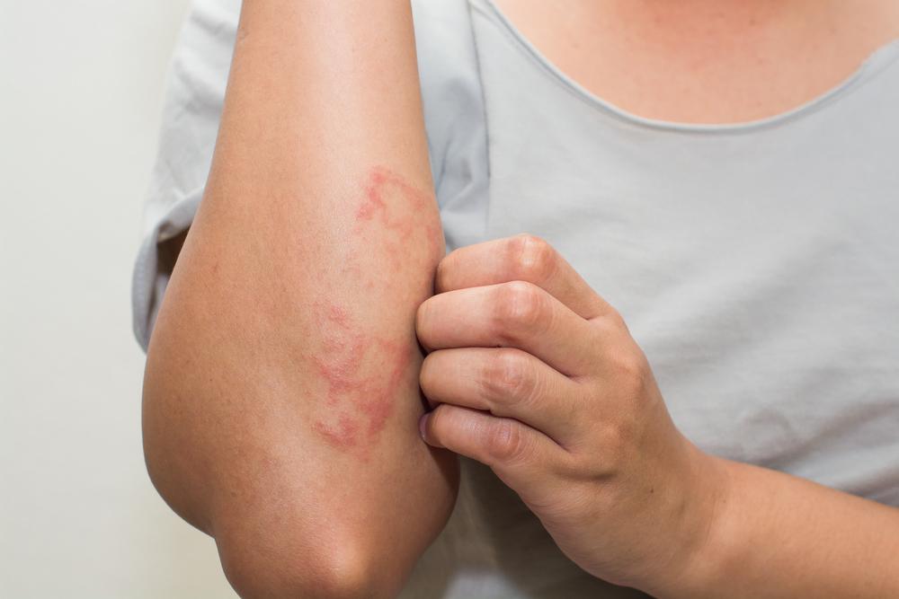 Symptoms and Treatment Options for Psoriasis