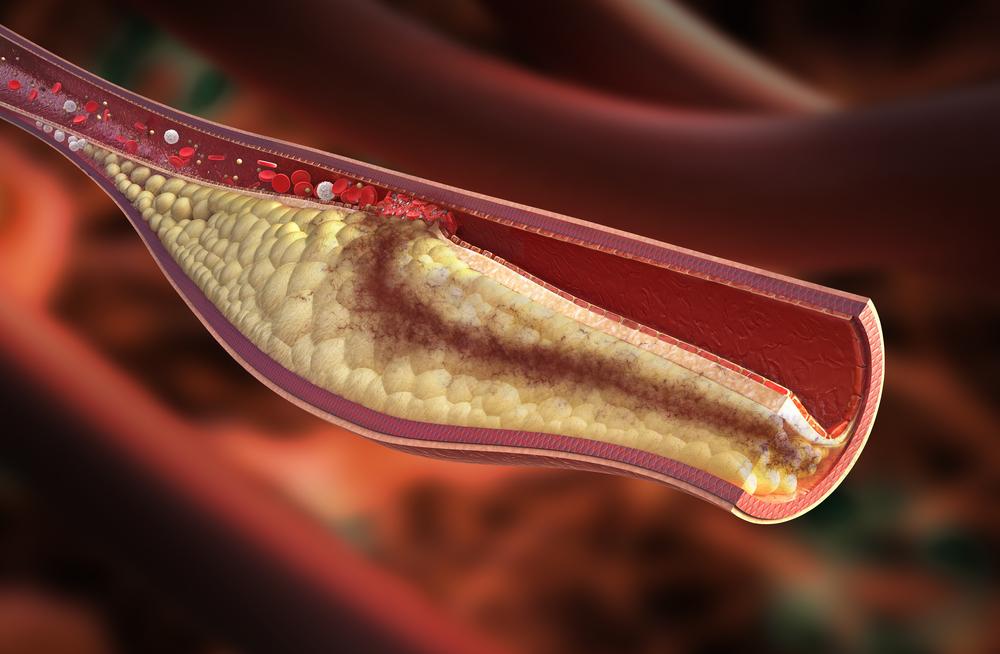 Types and causes of blood clots