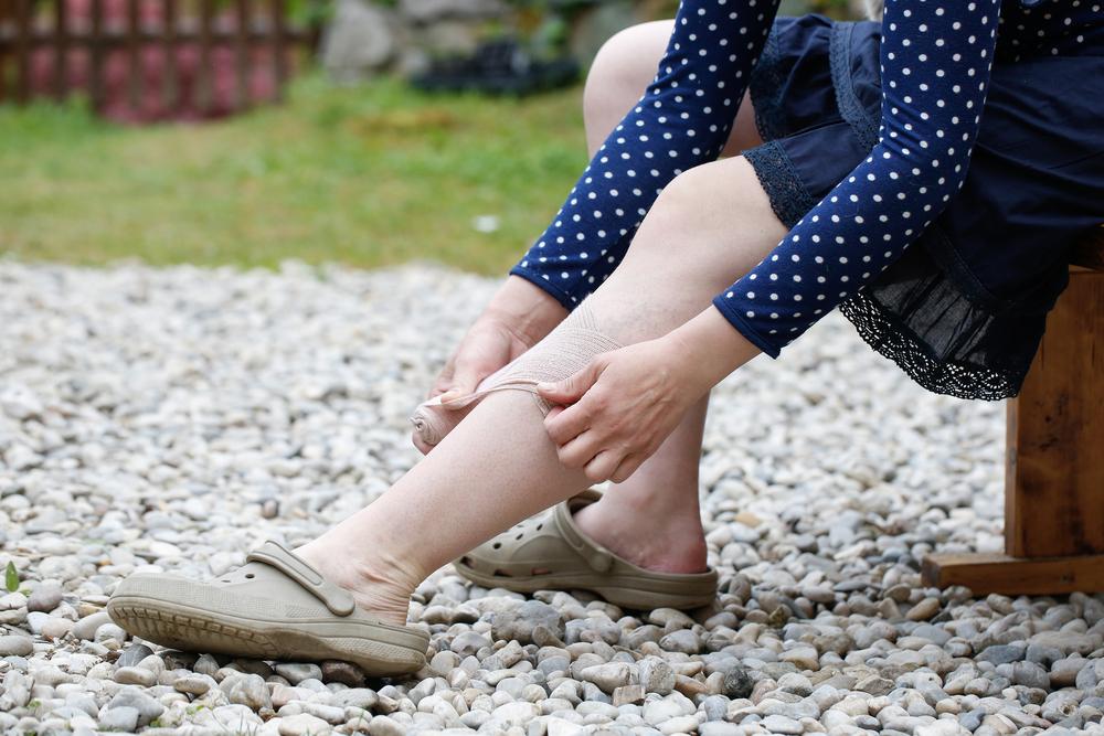 Tips to prevent the occurrence of deep vein thrombosis (DVT)