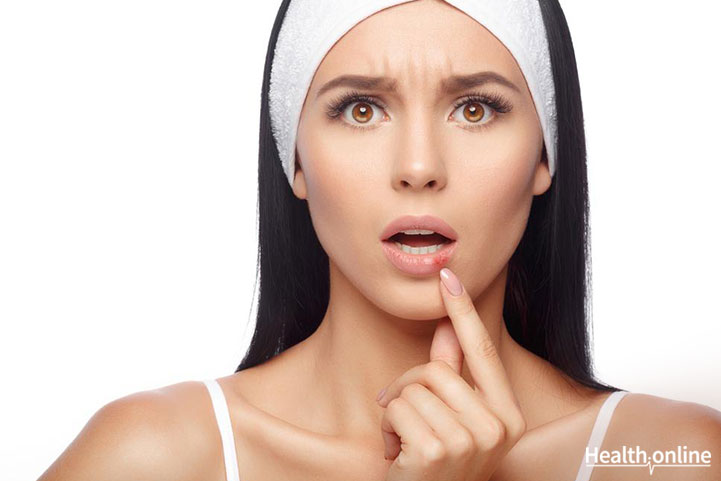 Herpes: What You Need To Know