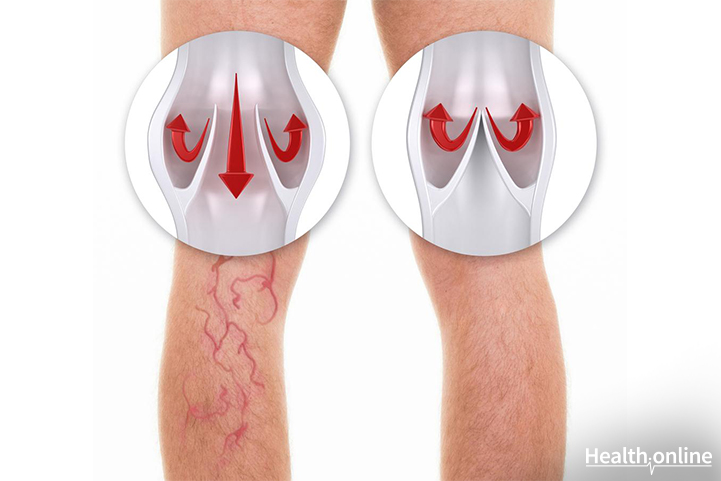 Mechanism of Varicose Veins