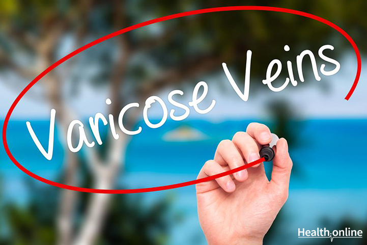 Introduction to Varicose Veins