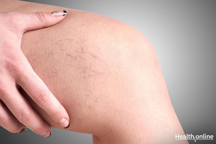 Symptoms and Risk Factors of Varicose Veins