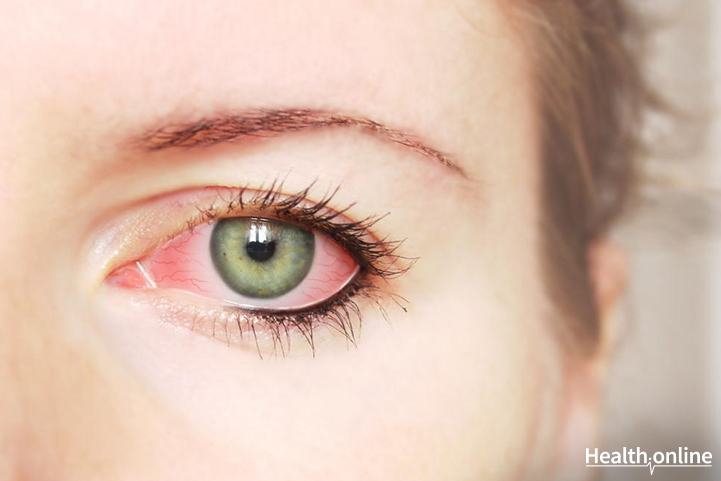 Glaucoma: An Overview