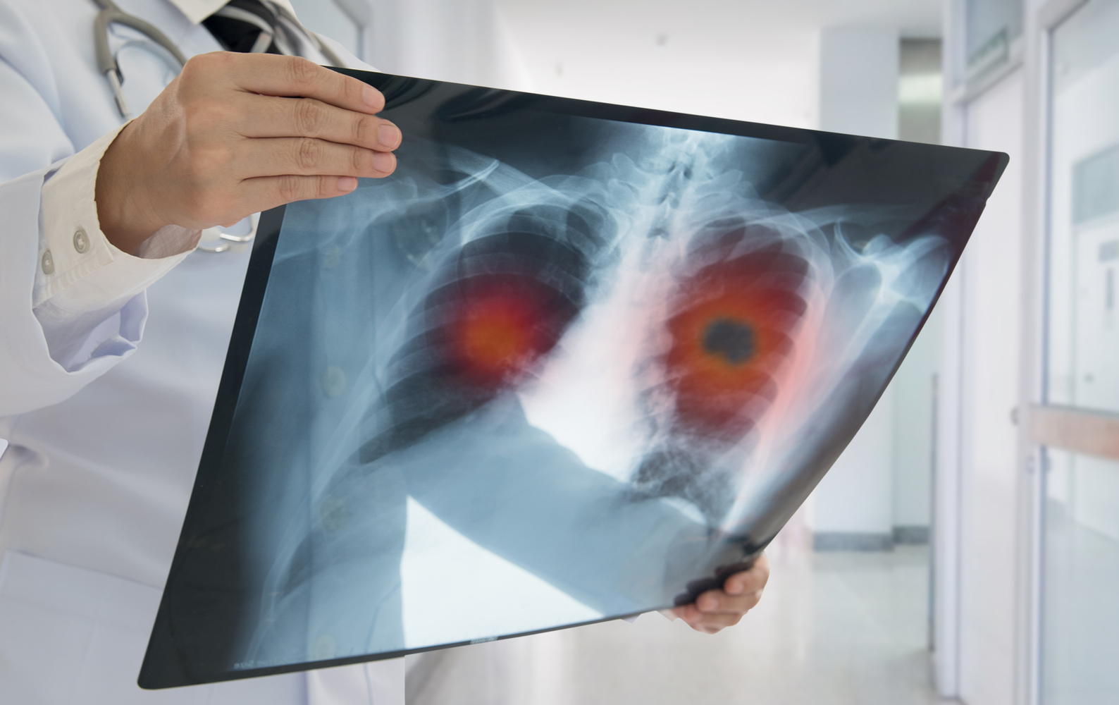 Lung Cancer Symptoms That Are Often Overlooked